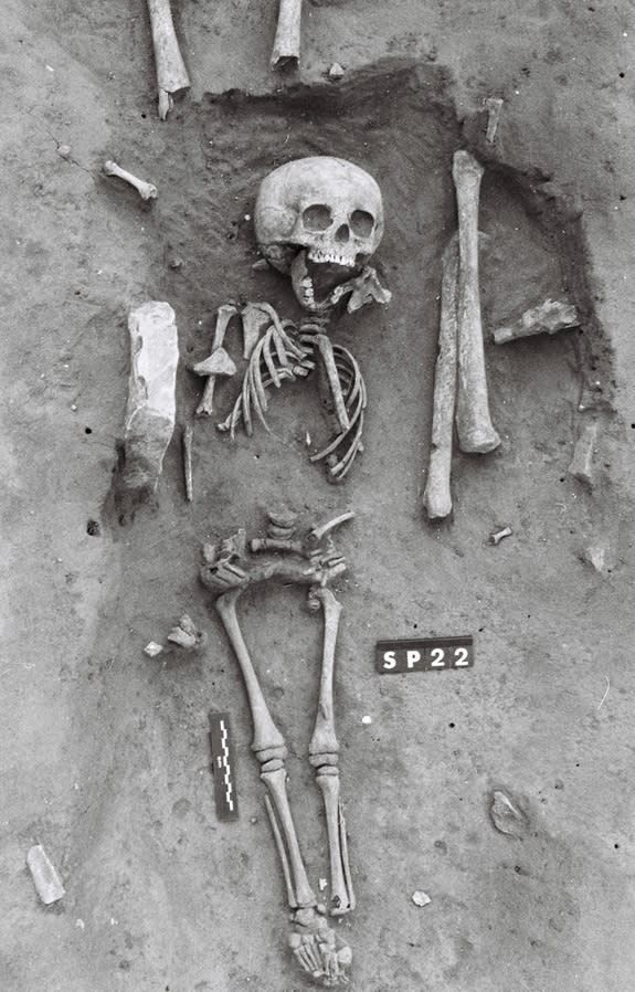 The skeleton of a 5- to 7-year-old child (shown here) who lived in medieval France shows signs of having Down syndrome, the earliest such case in the archaeological record.