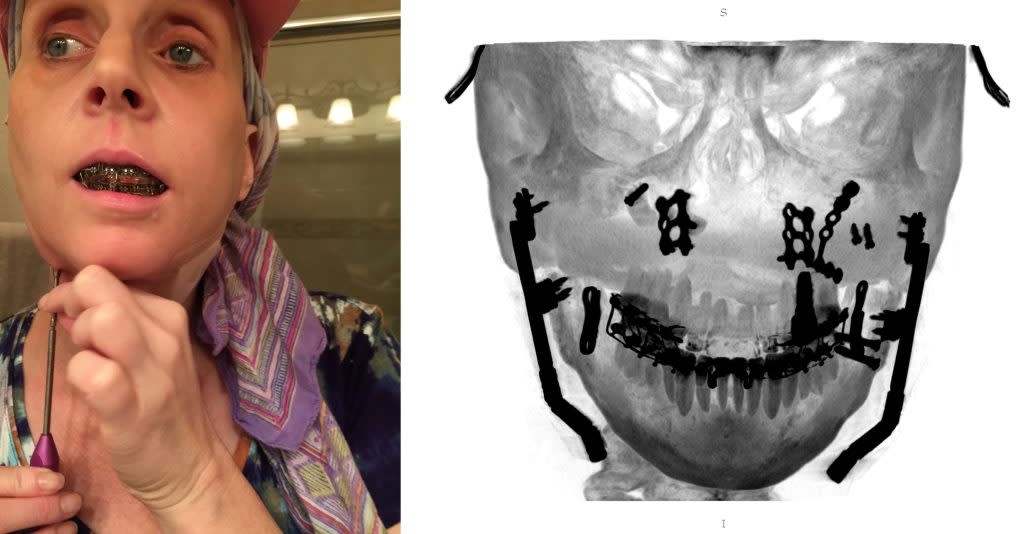 Left: Lisa Schmidt, who has been treated for TMJ disorders for decades, in 2017 uses a screwdriver to twist screws implanted in her jaw in an effort to restore bone that was cut away in previous TMJ-related surgeries. Right: A medical scan shows the screws and other TMJ-related hardware implanted in Schmidt’s face as of 2017. (Left: Provided by Mark Schmidt. Right: Medical scan provided by Lisa Schmidt; image created by Brett Kelman, KFF Health News, with RadiAnt DICOM Viewer software)