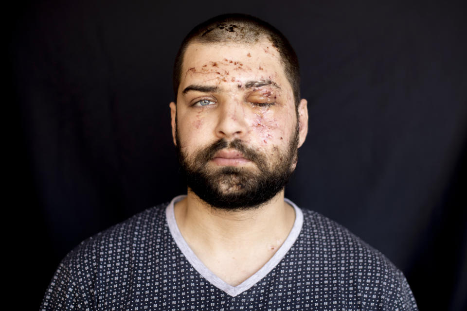 Hassan Nabha, 27, a computer and communication engineer, who got injured at his office during the Aug. 4 explosion that killed more than 170 people, injured thousands and caused widespread destruction, poses for a photograph at his parents' house in Khaldeh, south of Beirut, Lebanon, Saturday, Aug. 15, 2020. (AP Photo/Hassan Ammar)