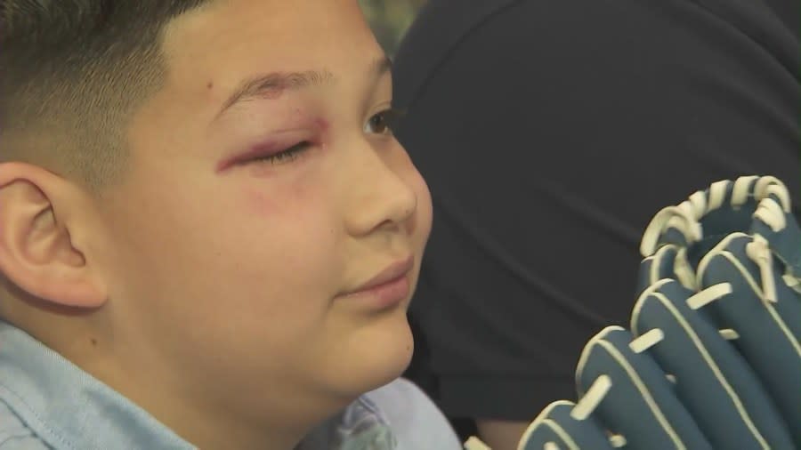 Nathan Sanchez was left with a black eye  after being hit in the face by a foul ball at Dodgers Stadium on May 17, 2024. (KTLA)