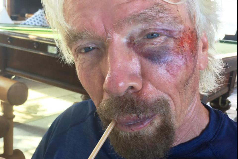 Back in 2016, the star cracked his cheek and tore several ligaments in a bike accident (VIRGIN/HANDOUT)