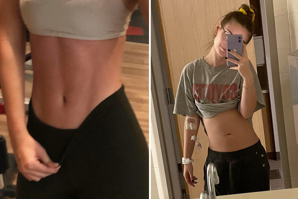 Jamie Bornscheuer's stomach before and after she developed rhabdomyolysis following core workouts. 