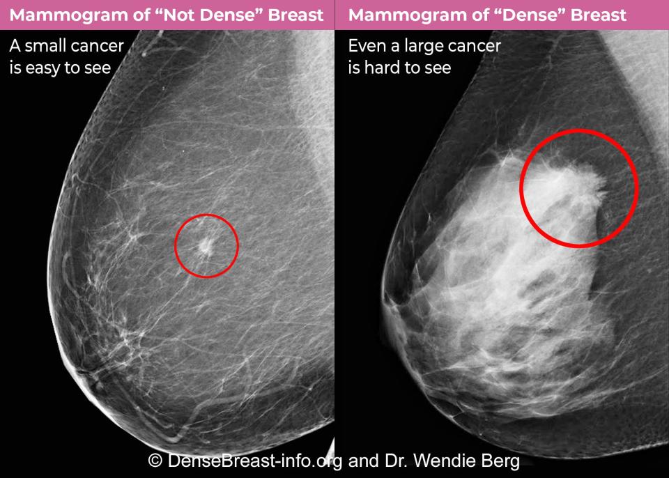 A side-by-side mammogram image of cancer in a "not dense" breast and a "dense" breast.