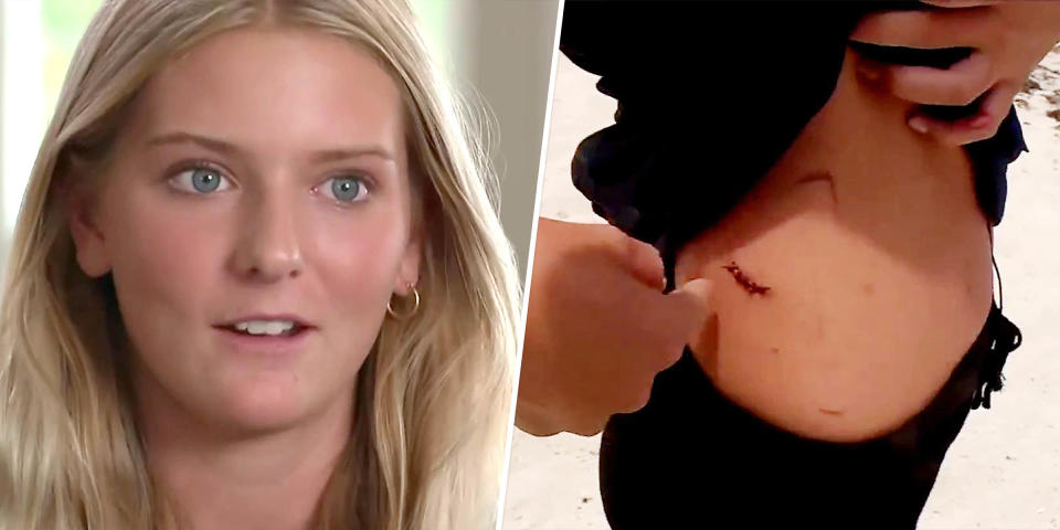 Ella Reed received stitches in her torso and leg after a shark attack in the waters near her Florida home last week. (TODAY)