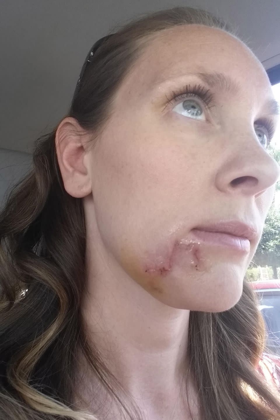 Kari was left with 35 stitches in her chin after the carcinoma was removed. Source: Caters