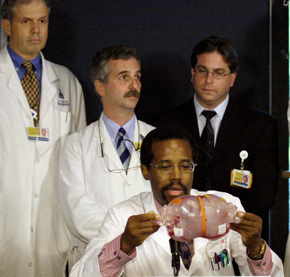 Johns Hopkins Children's Center Neurosurgeon Benjamin Carson (C) holds a model of the conjoined twins Lea and Tabea Block during a press conference, 16 September, 2004 in Baltimore, Maryland. Surgeons completed the separation of the twins from Lemgo, Germany, who had been joined at the head, but Tabea died of major complications associated with the surgery.&nbsp;