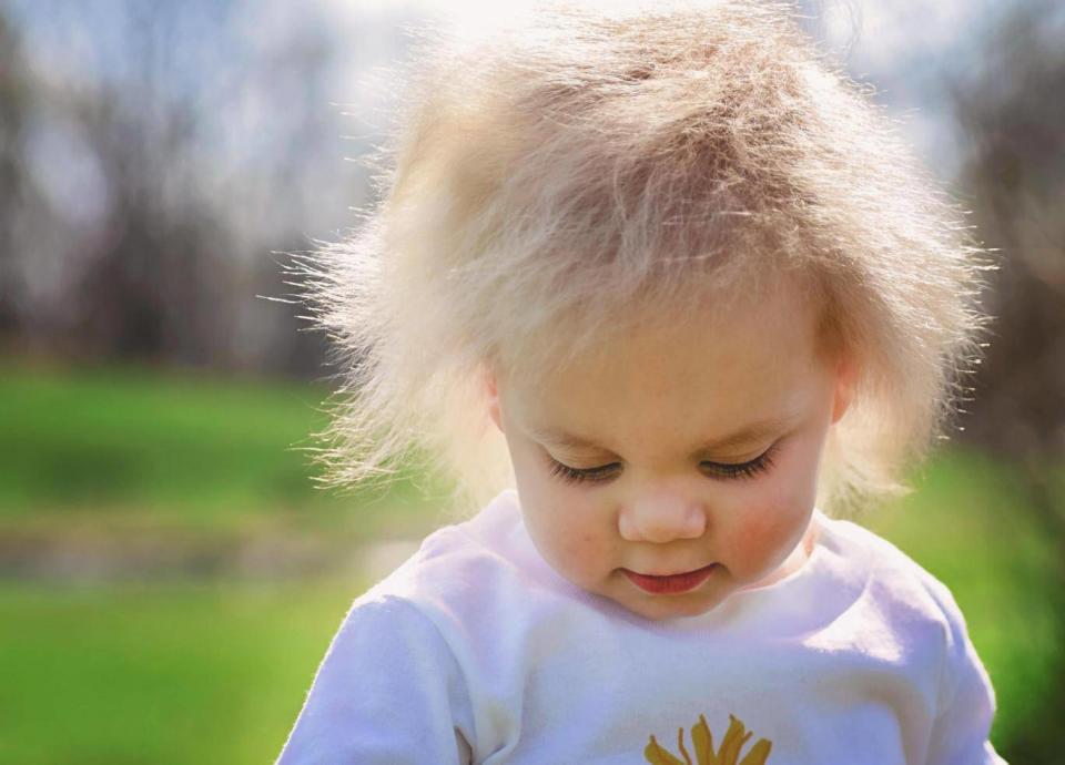 There are around 100 reported cases of 'Uncombable Hair Syndrome' from around the world (SWNS)