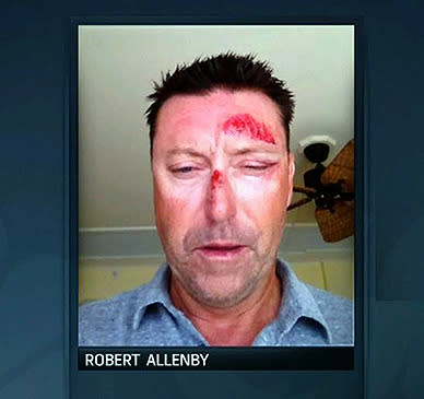 Robert Allenby took this selfie of his injuries.