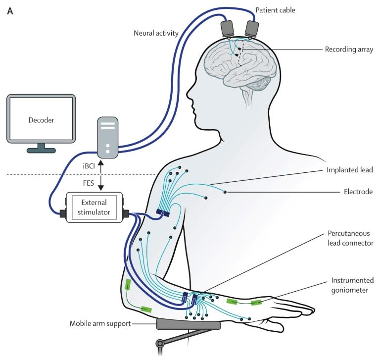 This handout image released on March 29 2017 by The Lancet journal shows a diagram depecting the restoration of reaching and grasping movements through brain-controlled muscle stimulation in a person with tetraplegia