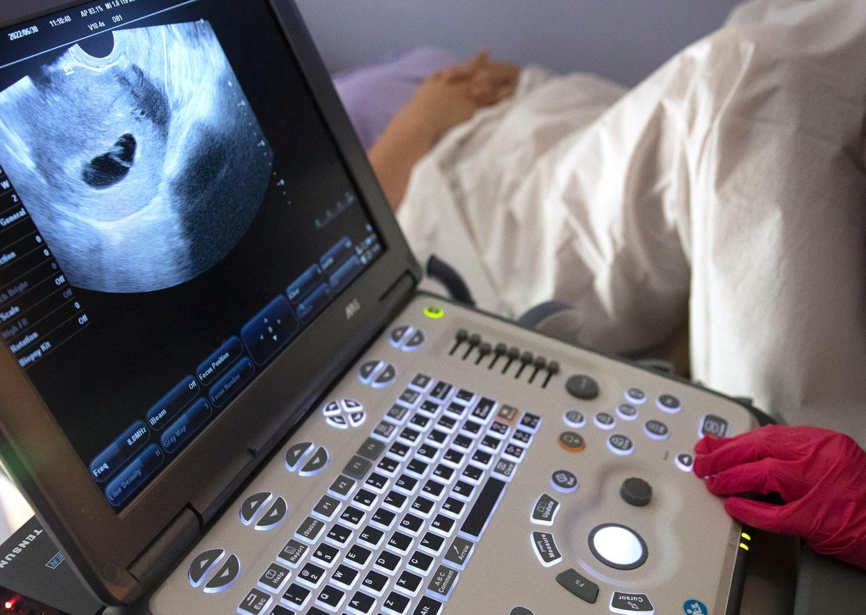 Dr. Catherine Romanos, with the Women's Med Center in Kettering, near Dayton, Ohio, performs a sonogram on a woman from Kentucky, Thursday, June 30, 2022. When Roe vs. Wade was overturned a week ago by the Supreme Court, Kentucky shut down all abortions because of trigger laws. Romanos identified the amniotic sac and said the pregnancy wasn't viable. At a little over six weeks, there was no heart beat.