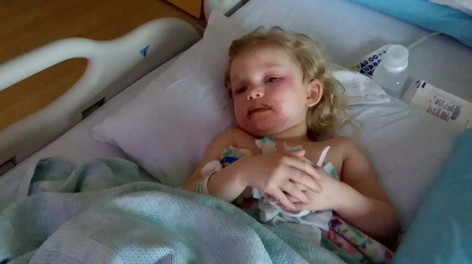 Lydia had to be rushed to the paediatrics ward because her blistering became so severe. Source: Facebook/Tony Kylie Cravens