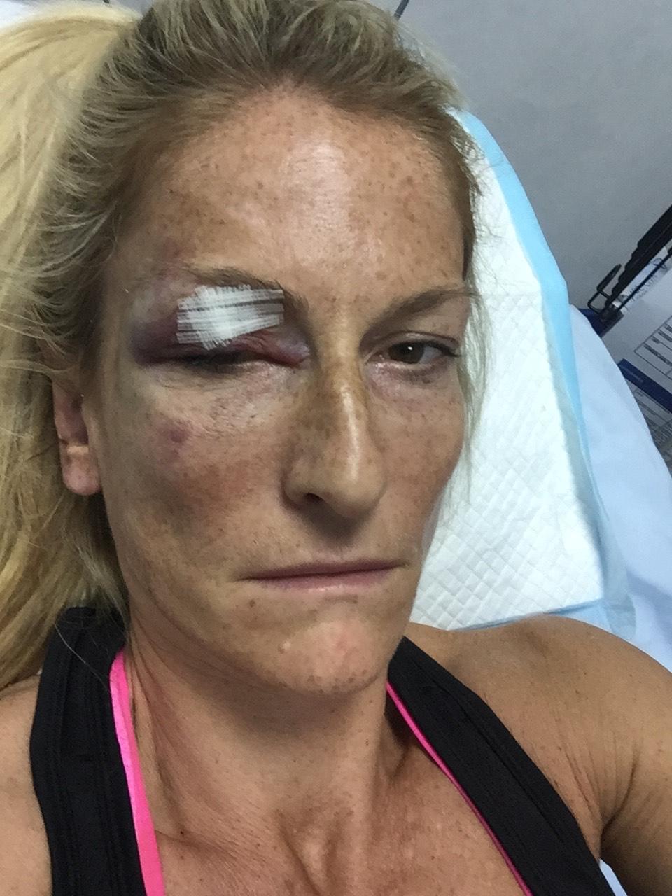 Alison Stockton says she 'was incredibly lucky to escape with so few injuries' after she blacked out while driving (supplied, Alison Stockton)