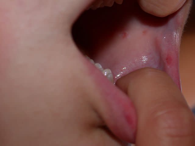 DermNet / CC BY-NC-ND​ Hand foot and mouth disease