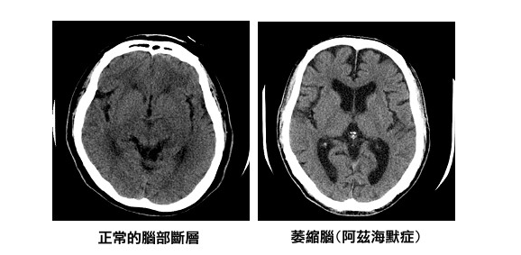 阿茲海默症對於智能退化是不可逆的，患者的腦部也會有相當性的萎縮（取自台灣失智症協會網頁）