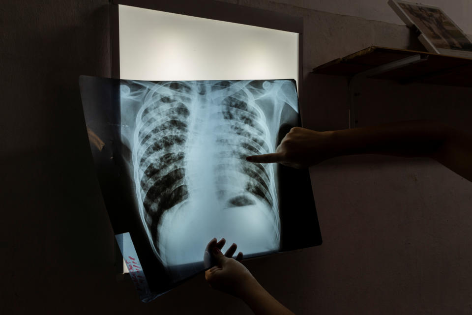 Mariela, an infectious disease specialist intern, analyses an X-ray of 24-year-old patient Jorge, who is currently undergoing treatment for tuberculosis, in Buenos Aires, Argentina, Jan. 29, 2019. Cases of the "white death" illness, closely linked to poverty, malnutrition and poor housing, have been on the rise since the turn of the decade as Latin America's third largest economy has grappled with repeat recessions and inflation. (Photo: Magali Druscovich/Reuters)