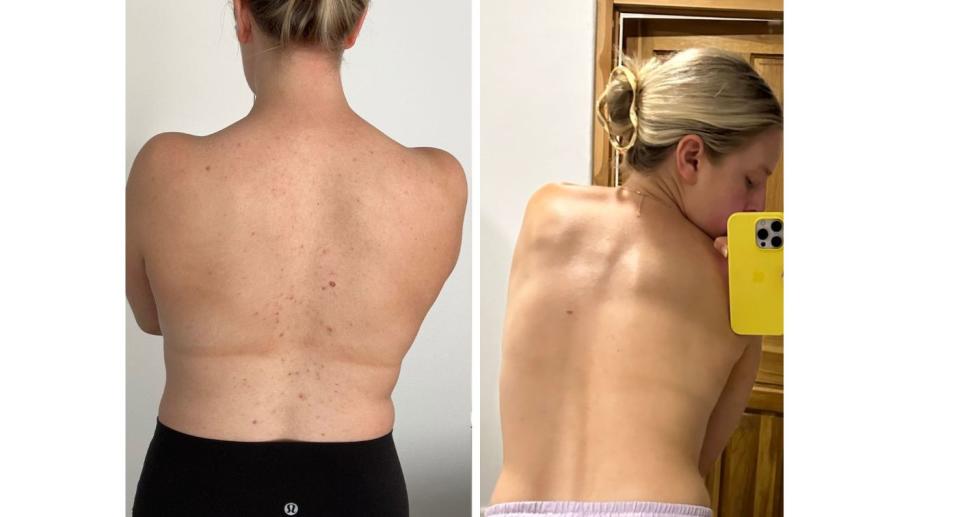 Before and after photos of spotty back