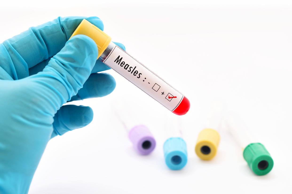Blood sample positive with measles virus.