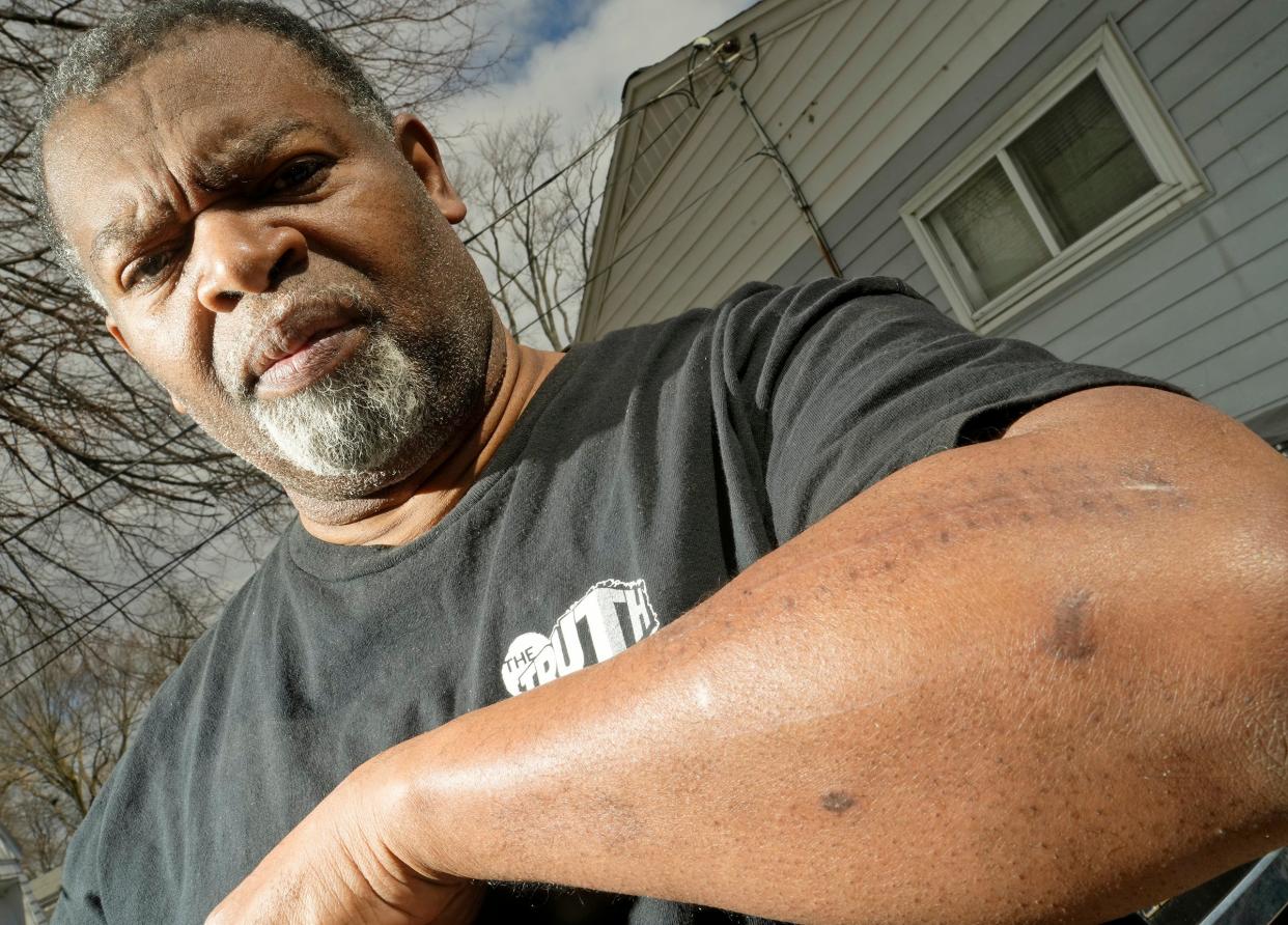 Pastor Kevin Simmons, who was shot during a carjacking in Milwaukee last fall, shows the scars from surgeries and bullets holes, while at his Milwaukee home on April 5.