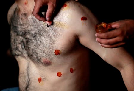 FILE PHOTO: A man with pellet injuries is treated inside a house in Srinagar