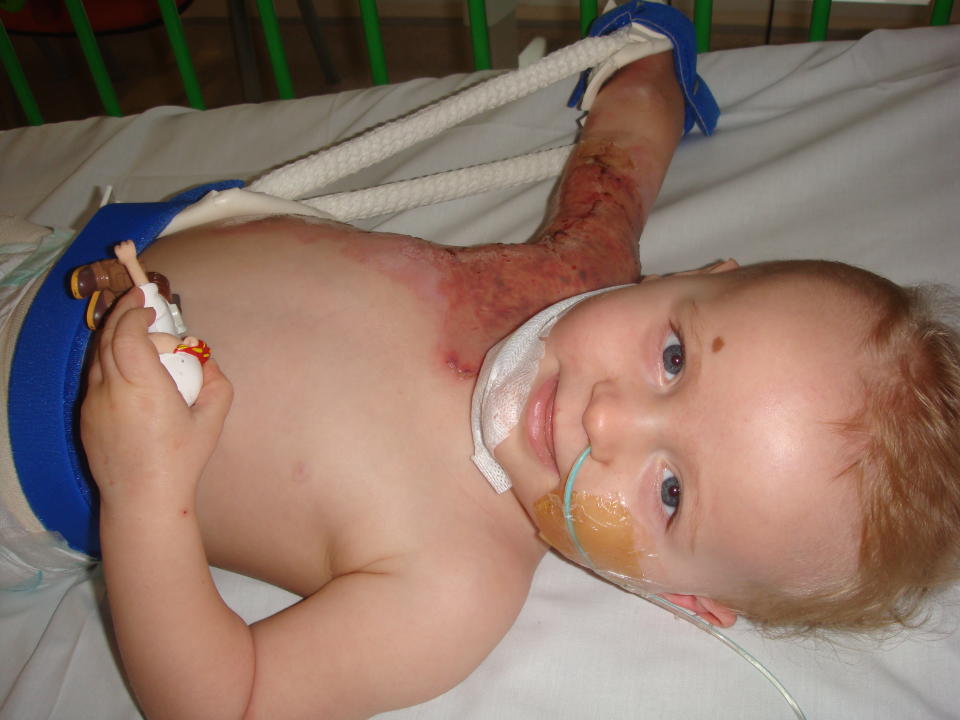 Charlie suffered severe burns across the right side of his chest, torso and arm (Collect/PA Real Life)