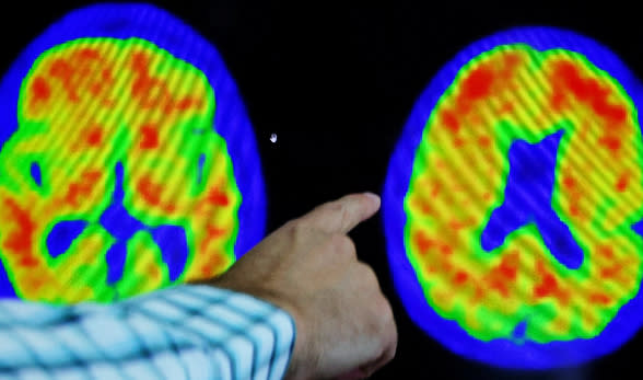 美國醫師解釋阿茲海默這患者腦部斷層掃描結果，圖為美國波士頓2023年3月30日。路透社