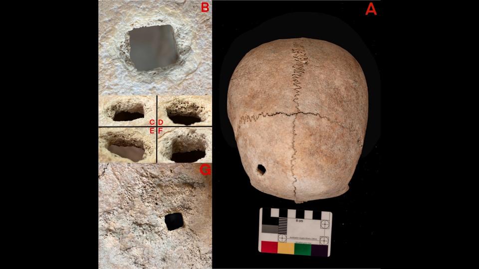 The latest study found evidence of blunt-force trauma to the woman's head, possibly from falling, and a square hole that appears to have been made by an ancient nail.