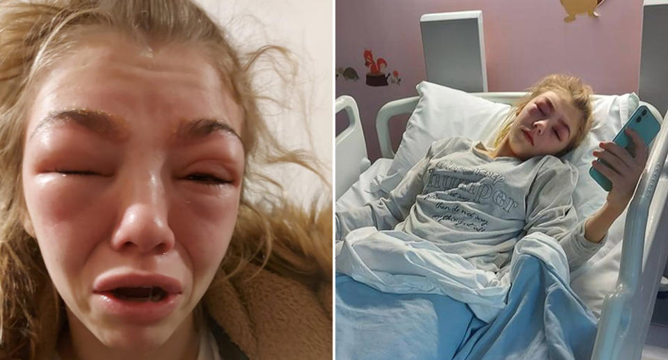 Cheyanne is pictured with a swollen face after getting a henna eyebrow and eyelash tint. Her mum, Rhia Vikki West, is warning parents.