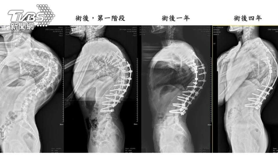 「龜背少年」番玉磊成功手術後每年定期追蹤，均維持良好狀態。(照片中醫大附醫提供)