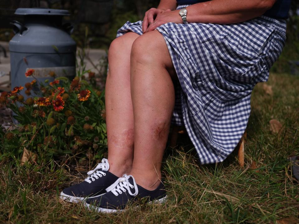 A photo of a woman's legs with burn scars.