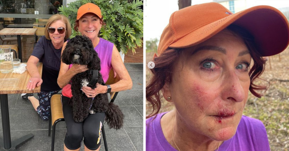 Lynne McGranger with injured face and lip after falling over