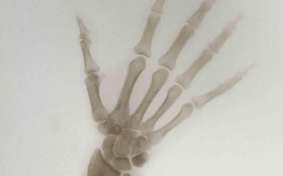 X-ray of the Hand and Wrist of Nicholas II, Emperor of Russia, 1898 - Harvard Medical Library