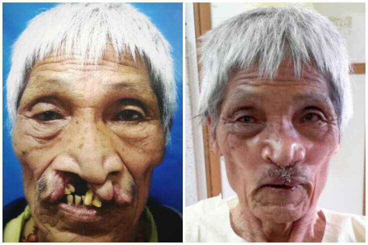 Paro, Bhutan, Sep 2015: Kuku Tashimo, 73, was the oldest patient to receive surgery to repair his bilateral cleft lip. He almost did not make the cut as general anaesthesia would have been risky for him due a severe pre-existing chronic lung condition, but he braved the operation under local anaesthesia. Credit: Smile Asia Facebook page