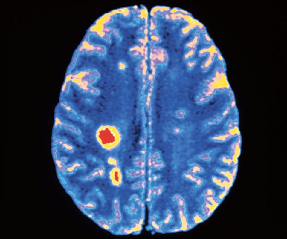 Multiple sclerosis, a chronic disease, may take 40 years to run its course. In developing drugs to slow its progression, doctors have used brain scans to show lesions (Science Photo Library)