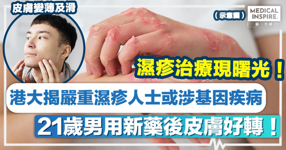 濕疹新療法 │ 港大揭嚴重濕疹人士或涉基因疾病、21歲男用新藥後皮膚好轉！