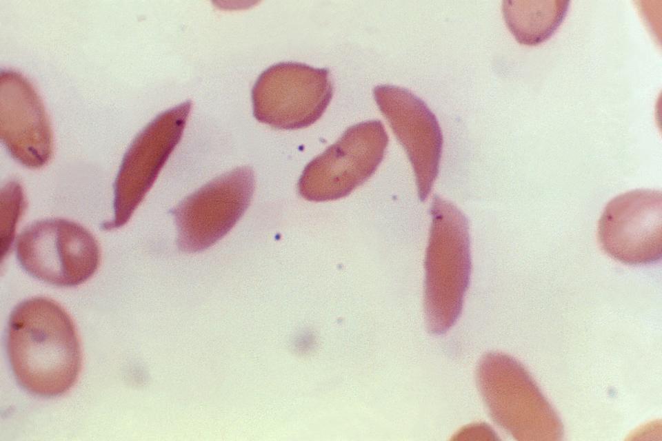 This microscope photo provided by the Centers for Disease Control and Prevention shows crescent-shaped red blood cells from a sickle cell disease patient in 1972. The disorder affects hemoglobin, the protein in red blood cells that carries oxygen. A genetic mutation causes the cells to become crescent-shaped, which can block blood flow and cause excruciating pain, organ damage, stroke and other problems.