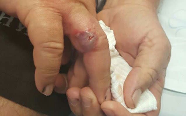 His finger quickly deteriorated after two days. Source: Supplied