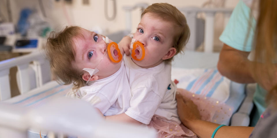 Sarabeth and Amelia Irwin before their separation surgery. (Joe Hallisy / Michigan Medicine)