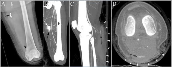 This image shows the injuries to the legs of a bombing victim whose bones were separated at the knee joint in the left. The patient had to undergo an urgent amputation at the knee level. Panel A shows the victim’s leg after amputation, black ar