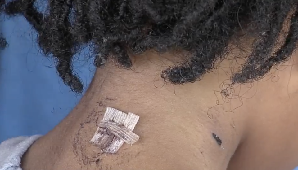 A patched-up bullet wound on Zendaya Cook's neck. 