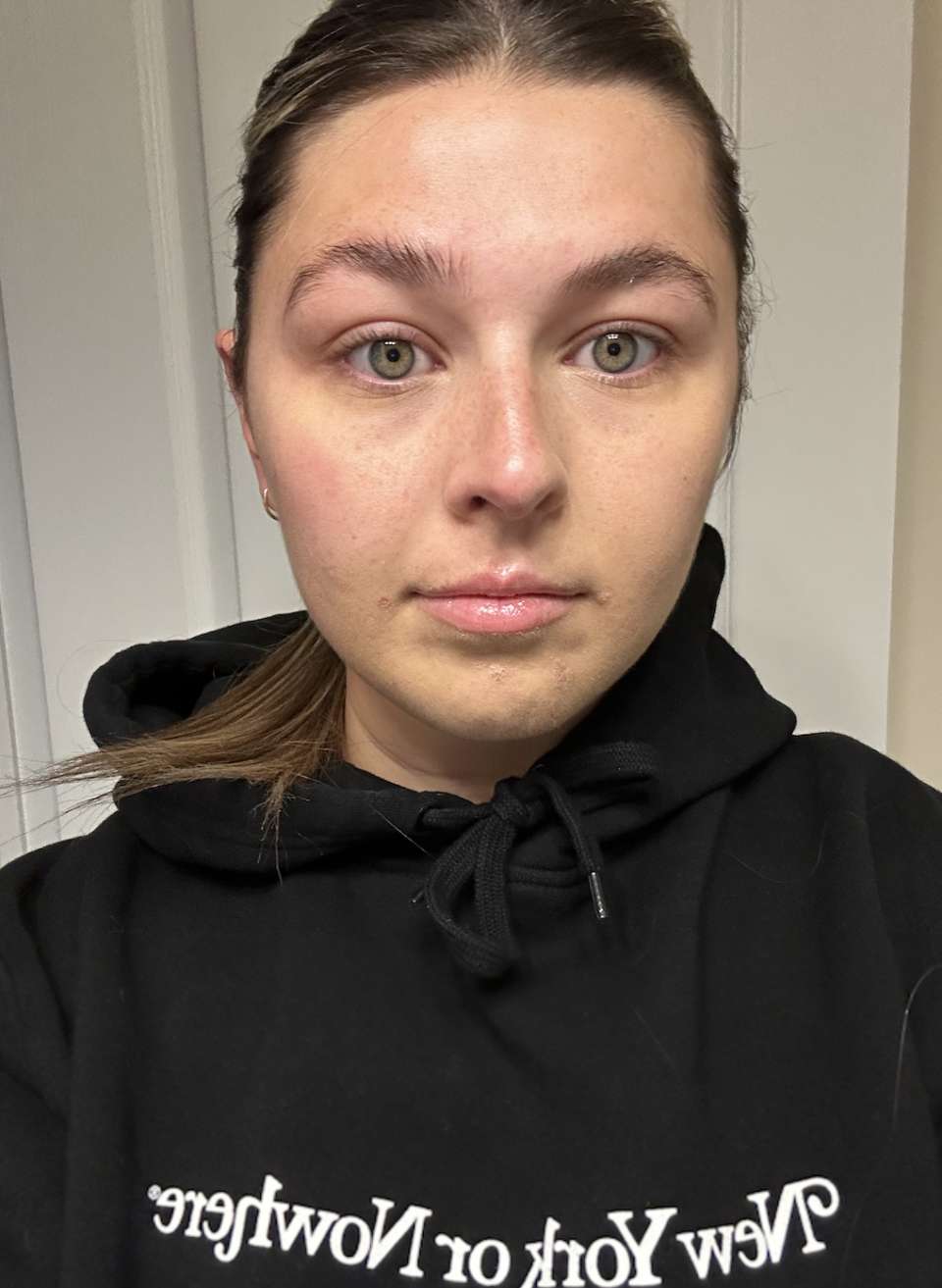 To show the impact of the device in just one use, I used it on just half of my face this day. The results are subtle, but noticeable. The right side of the photo is slightly lifted and my jaw is less rounded than the other side. (Photo via author)