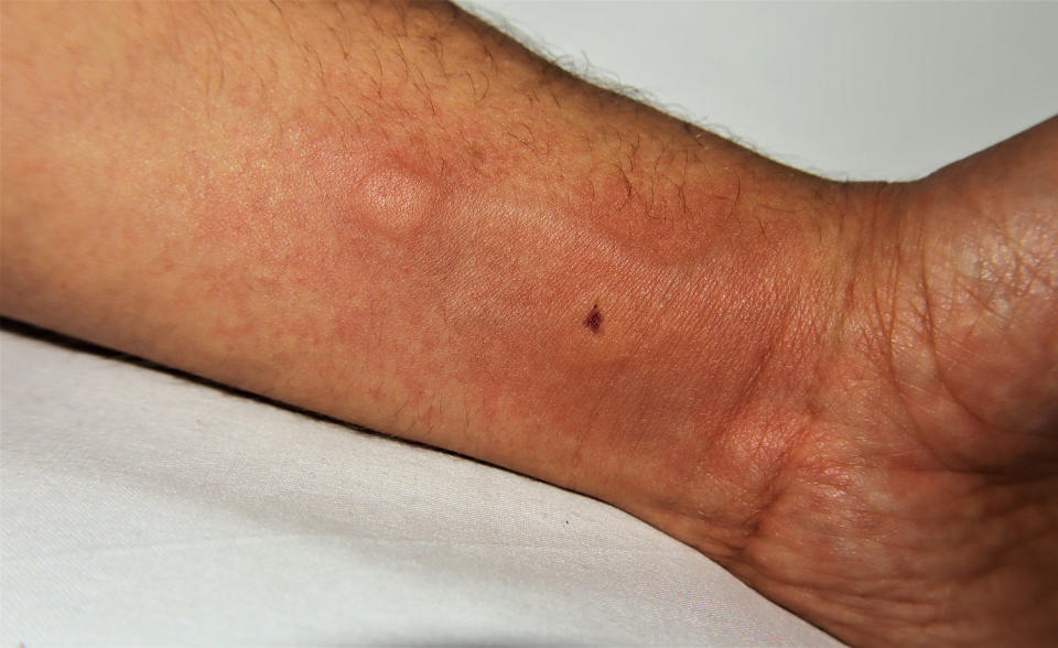 Two bee stings on the arm of a man. (Dr-MYM / Getty Images)