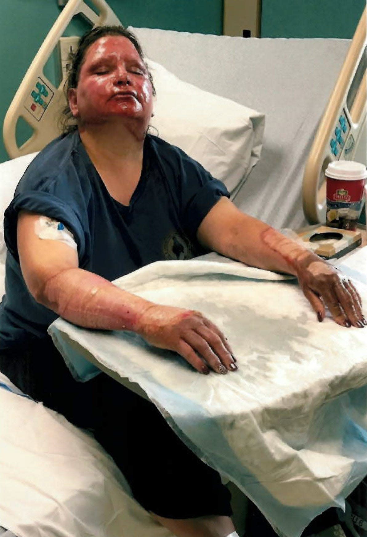 Tammy Reese is pictured in the hospital after cooking spray "over-pressurized and exploded" in the kitchen where she was working in Shippensburg, Pennsylvania. An Illinois jury has awarded her $7.1 million four years after she sued cooking spray manufacturer Conagra.