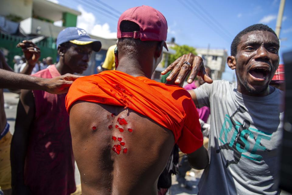 A protester shows his wounds caused by rubber bullets fired by police to disperse protesters demanding the resignation of President Jovenel Moise in Port-au-Prince, Haiti, Saturday, Oct. 17, 2020. The country is currently experiencing a political impasse without a parliament and is now run entirely by decree under Moise. ( AP Photo/Dieu Nalio Chery)