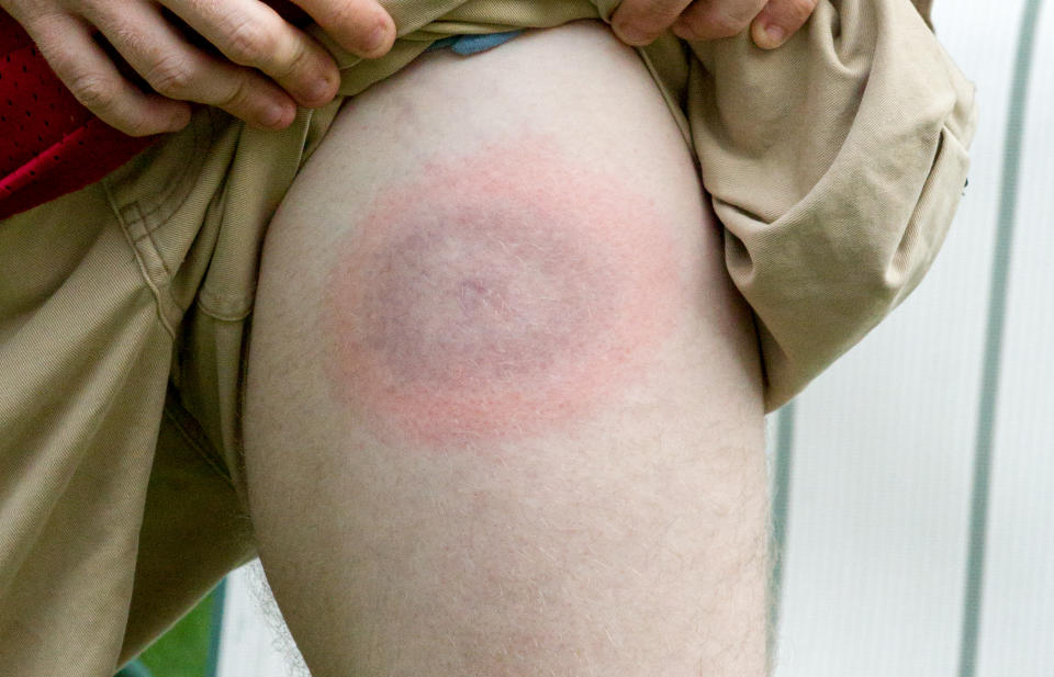 Lyme disease rash. (Getty Images)