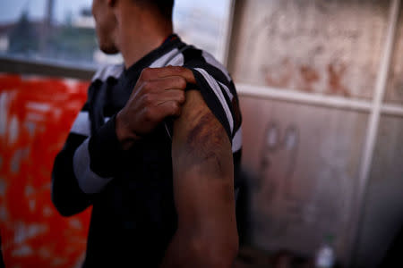 A migrant who crossed the Evros river from Turkey to Greece, demonstrates his bruised arm in the village of Pythio, Greece, May 1, 2018. REUTERS/Alkis Konstantinidis