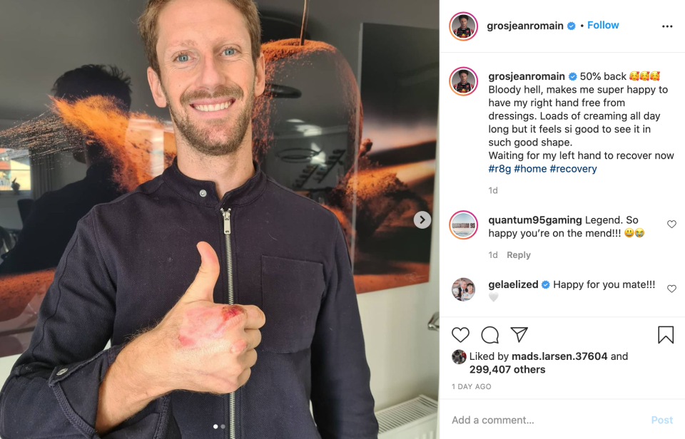 Romain Grosjean revealed the burns suffered to his right hand after having his dressing bandages removed (Instagram/grosjeanromain)