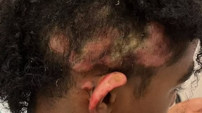 This unnamed 13-year-old student in Henrico County, Virginia, suffered second and third-degree burns last week when a schoolmate set his hair on fire in front of their class. (Photo: Screenshot/Fox 19)