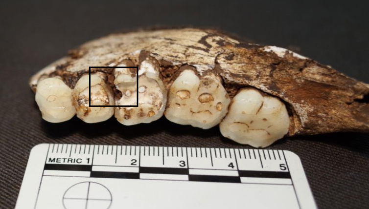 <span class="caption">Carious lesions on the mandibular right second premolar and first molar. Homo naledi (UW 101-001).</span> <span class="attribution"><span class="source">Ian Towle</span></span>