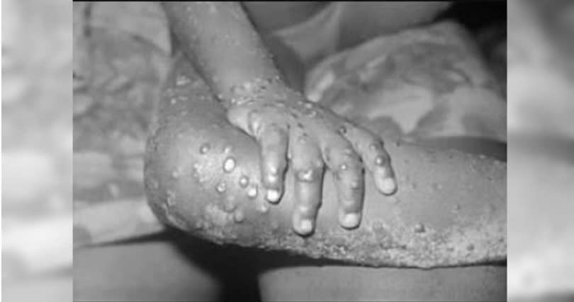 皮膚冒出明顯凹凸皮疹，是感染猴痘的主要症狀之一。（圖／維基百科）