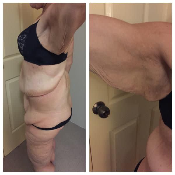 Jennifer has a lot of excess skin since losing weight. Image: provided.